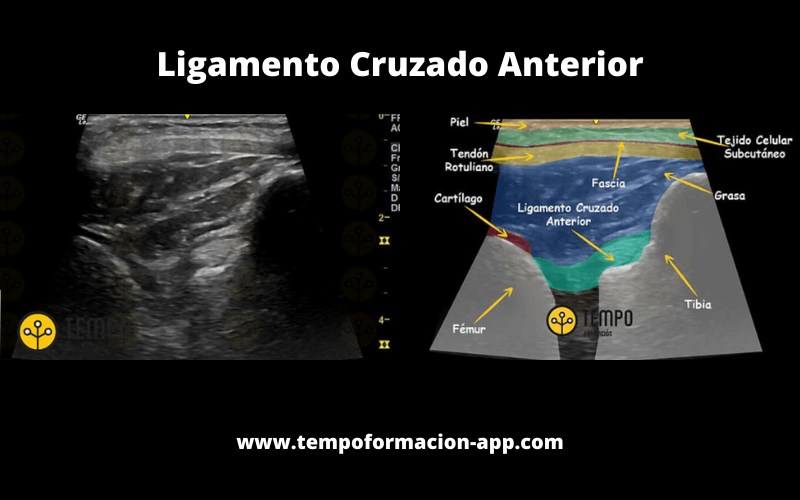 Ligamento Cruzado Anterior Anatomía Ecografía.png